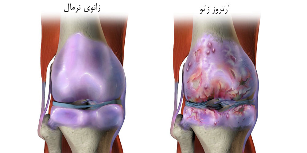 آرتروز زانو در اثر چیست