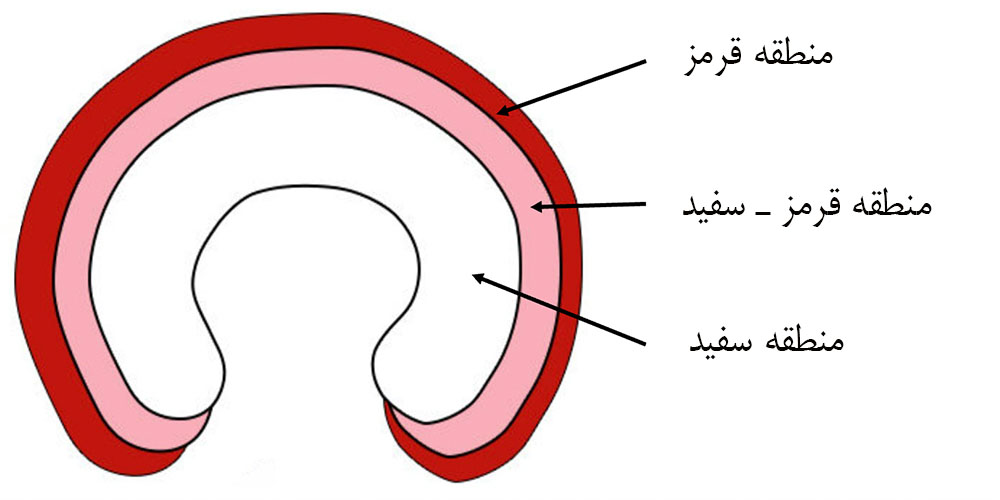 علائم پارگی مینیسک زانو 