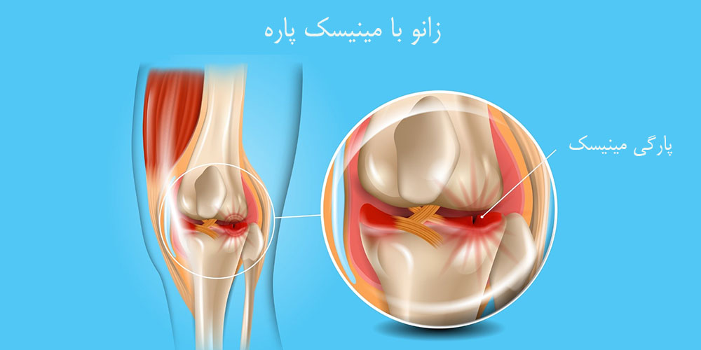 خالی کردن زانو هنگام برخاستن 