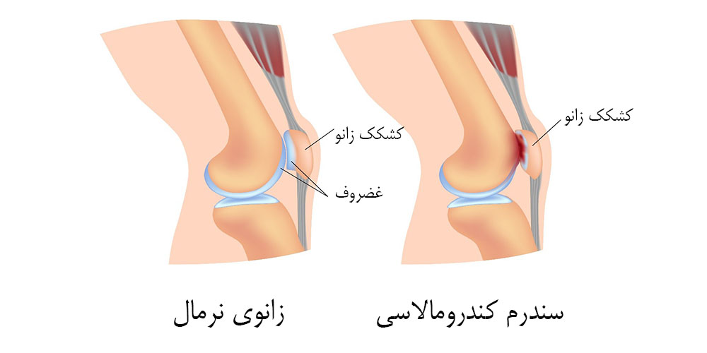 زانو درد لحظه ای 