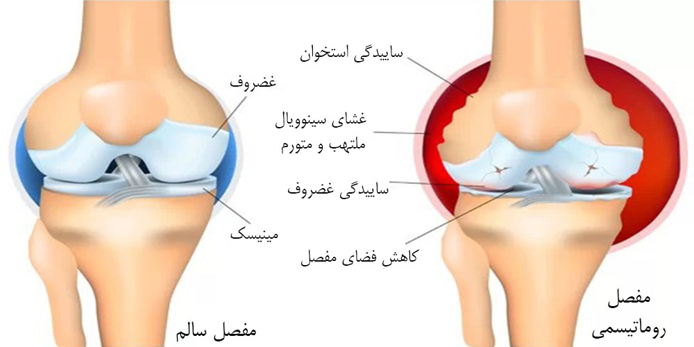 علت خالی کردن زانو 