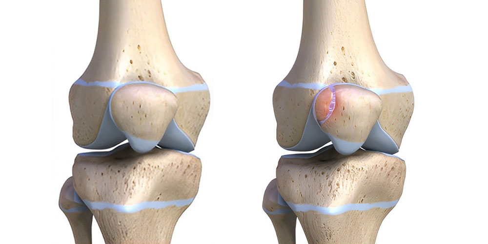 علت زانو درد ناگهانی 