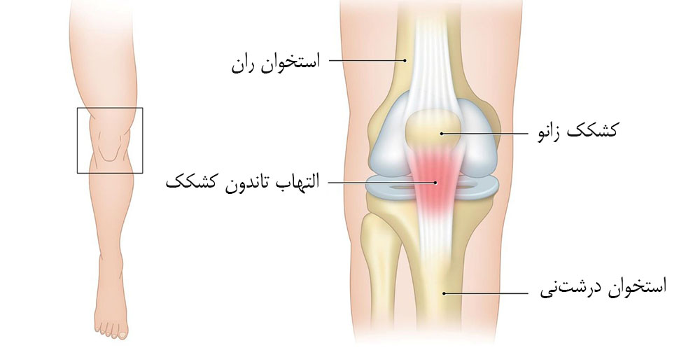 زانو درد بعد از ورزش 