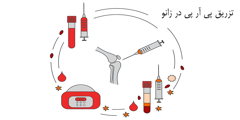 تزریق پی آر پی زانو چیست