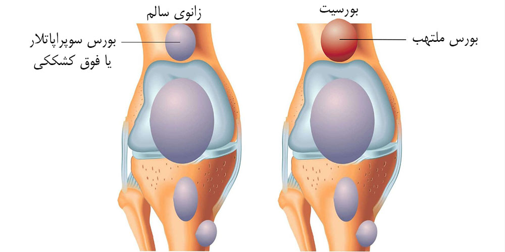 زانو درد خفیف 