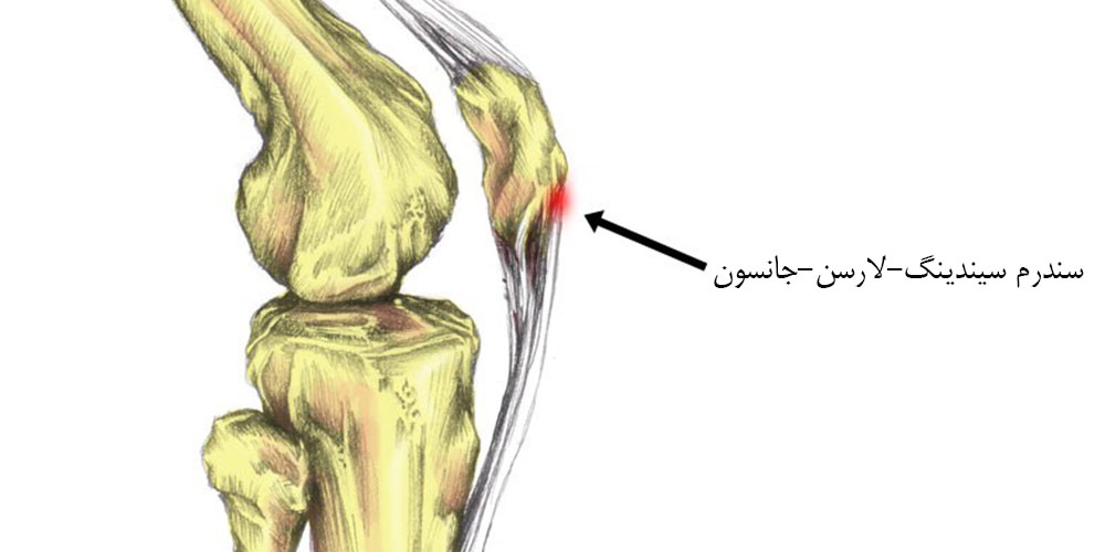 زانو درد در اثر پیاده روی 