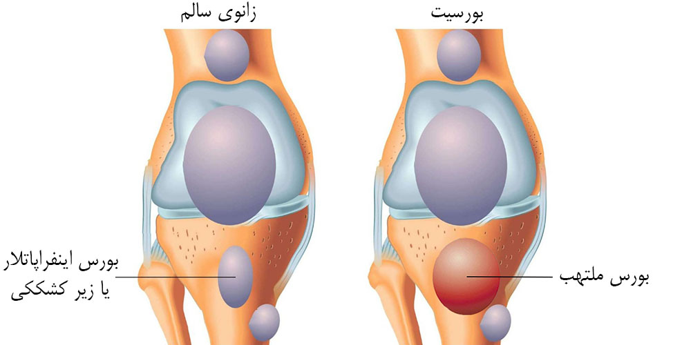 درمان زانو درد 