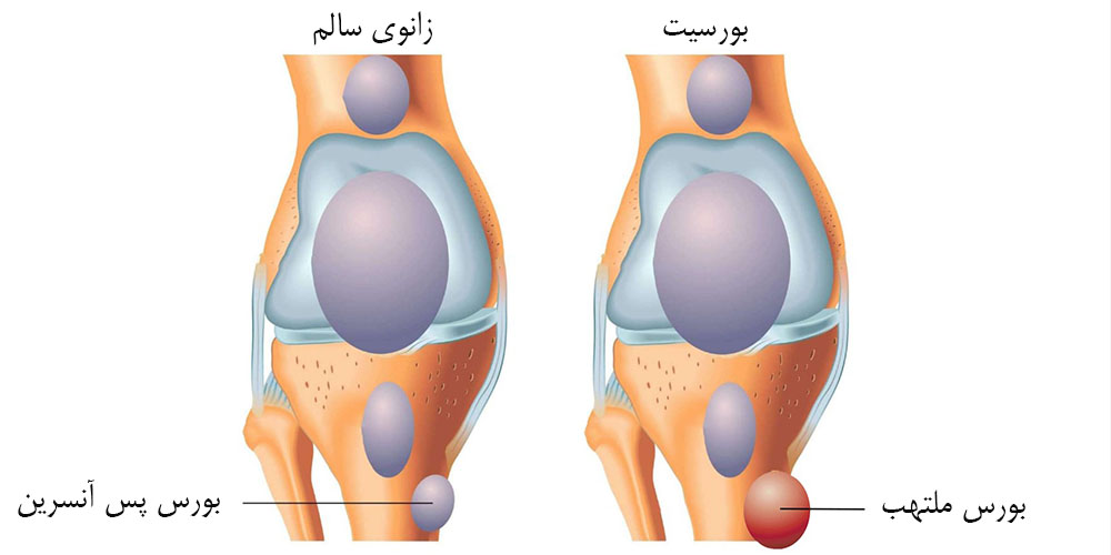 زانو درد و بی حسی پا 