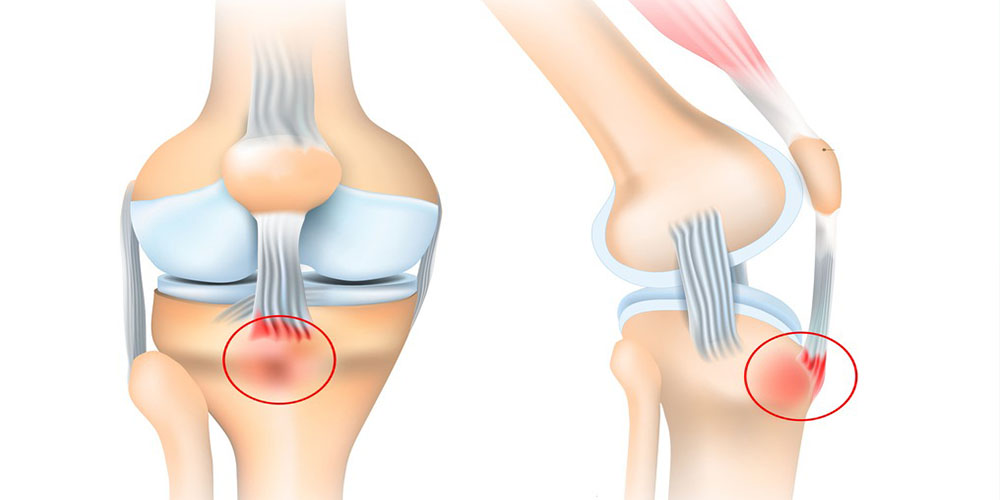 زانو درد به چه دلیل است 