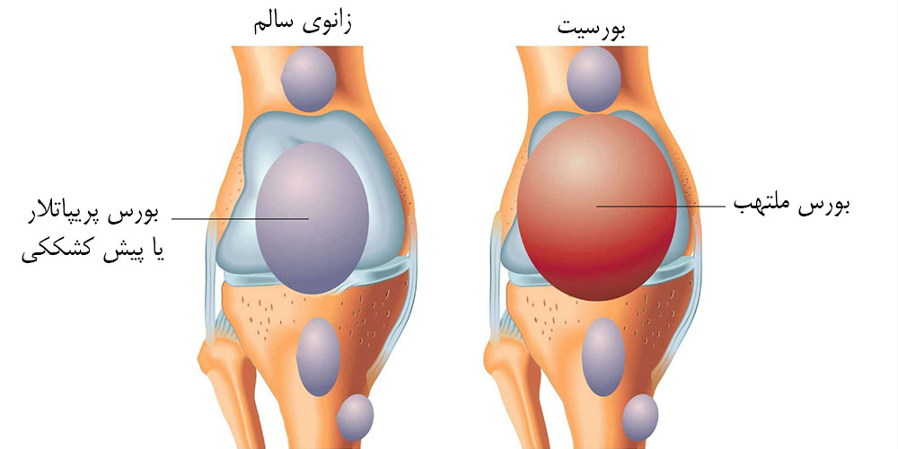 زانو درد با دوچرخه سواری