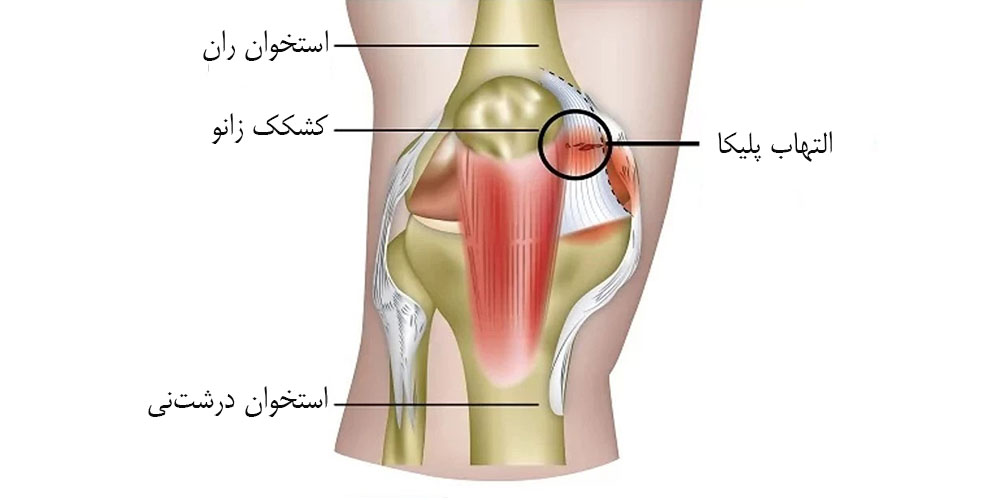 زانو درد مینیسک 