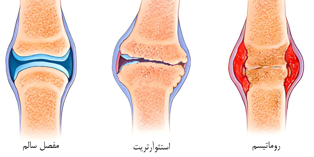 زانو درد لحظه ای 