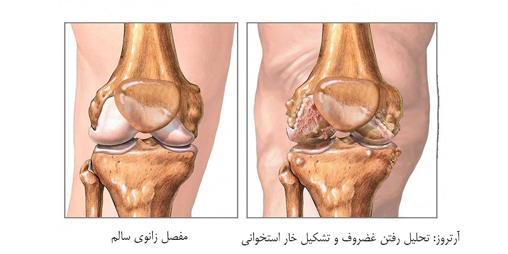 آیا آرتروز زانو ارثی است 