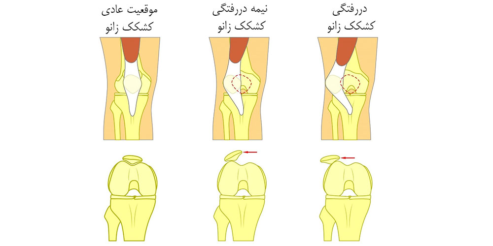 خالی شدن ناگهانی زانو 