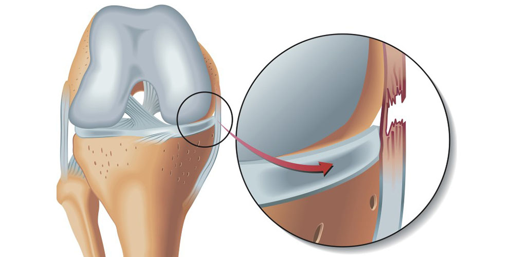درمان قطعی زانو درد 
