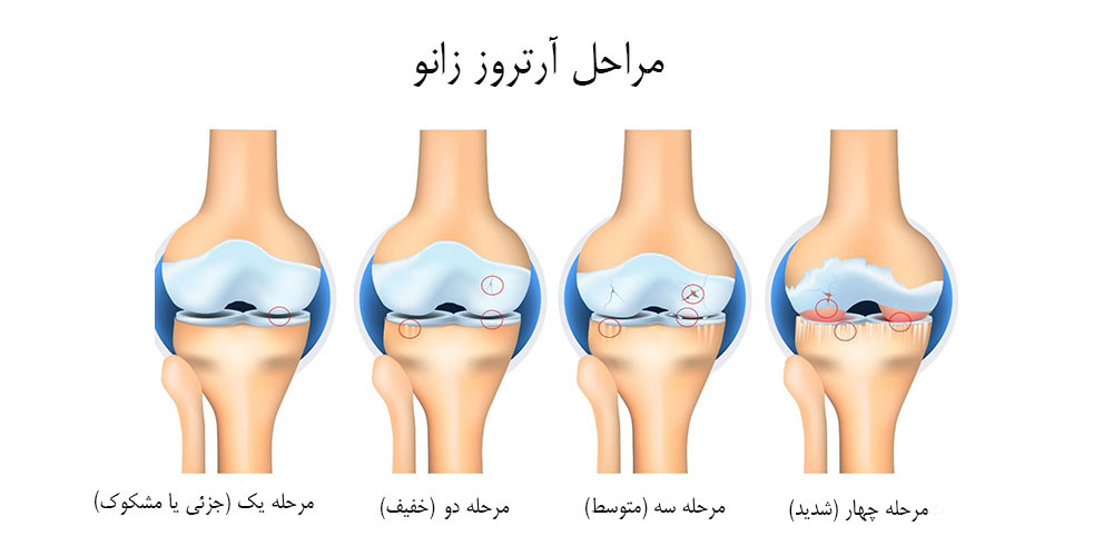  آرتروز زانو در جوانی 