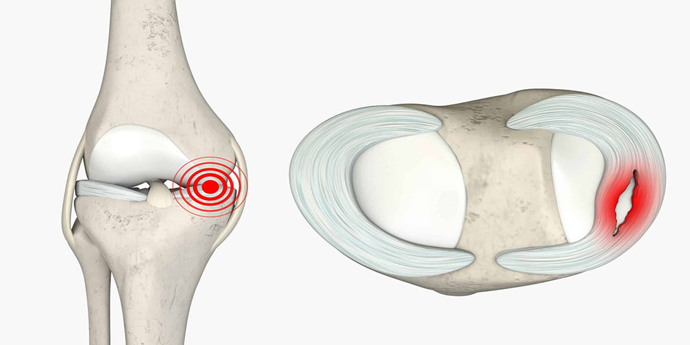 علائم پارگی مینیسک زانو در بزرگسالان
