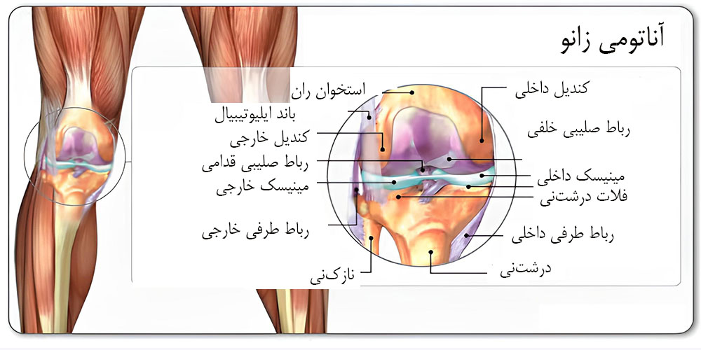 پارگی مینیسک زانو چیست 