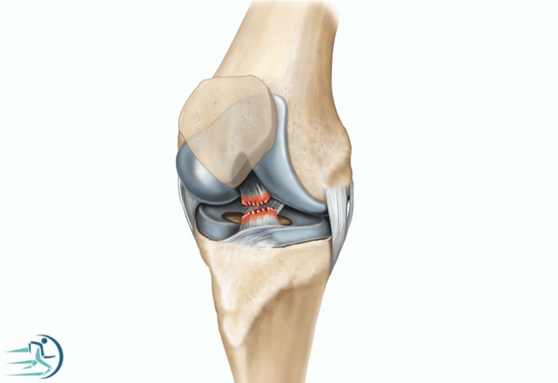 پارگی رباط صلیبی قدامی از علل درد جلوی زانو