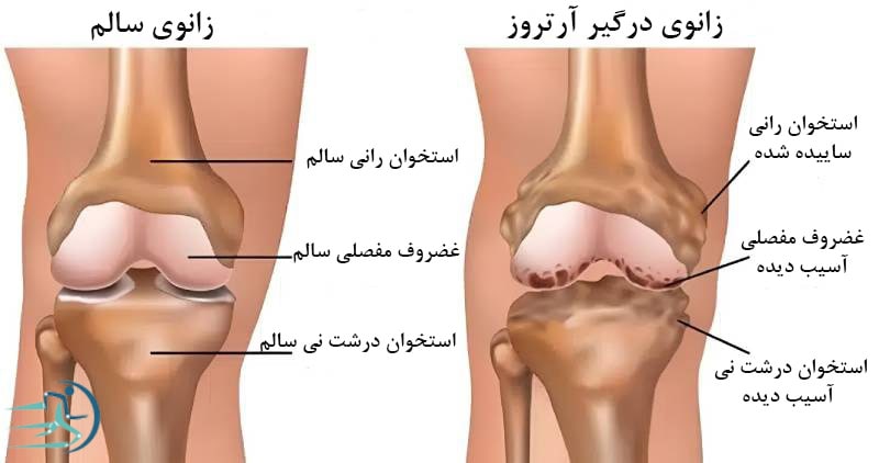 آرتروز زانو از علل درد جلوی زانو