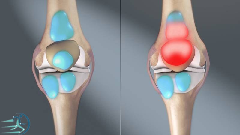 التهاب بورسیت از علل درد جلوی زانو