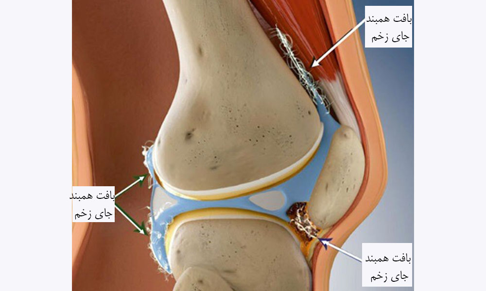 علت خشکی و سفتی زانو 