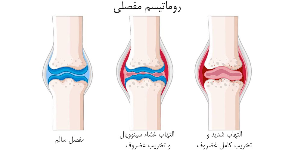 درمان خشکی و سفتی زانو