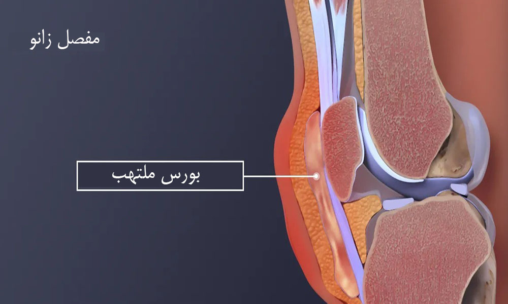 خشکی و سفتی زانو بعد از ورزش 