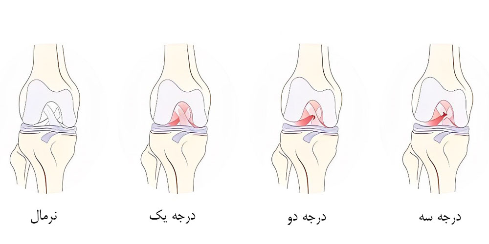 درمان پارگی رباط صلیبی 