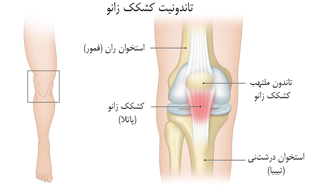 علت خشکی و سفتی زانو 