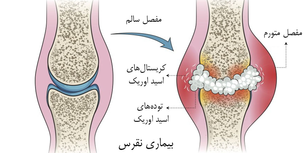 درمان خشکی و سفتی زانو 