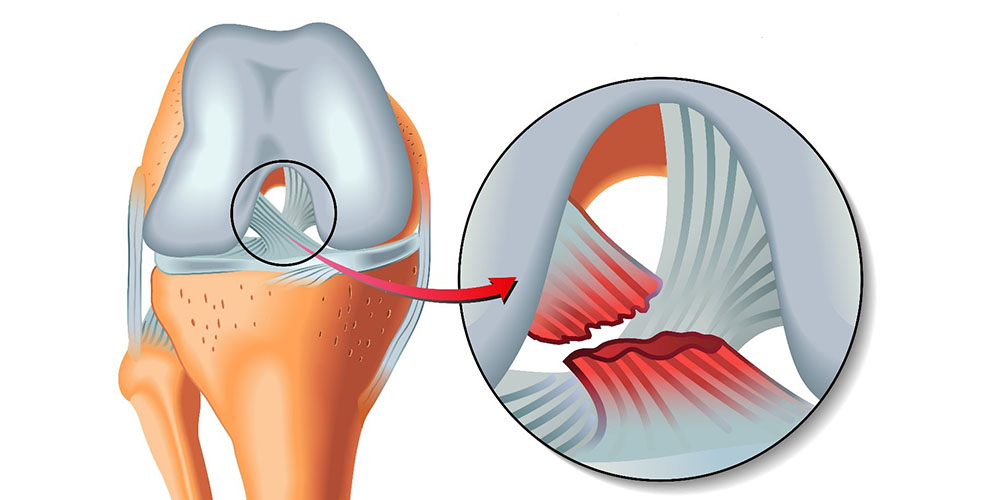 آیا پارگی رباط صلیبی خطرناک است 
