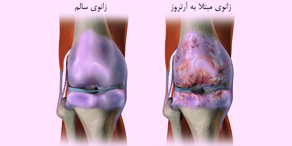 خشکی و سفتی زانو هنگام راه رفتن 