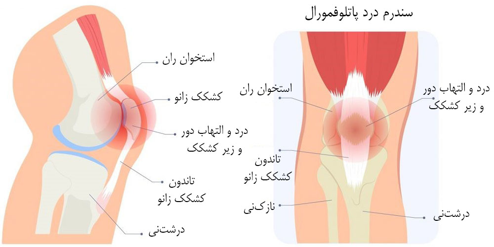 خشکی و سفتی زانو هنگام راه رفتن 