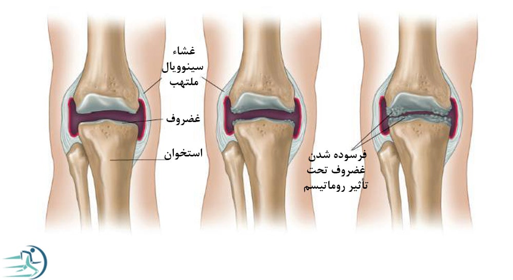 آب آوردن زانو بر اثر روماتیسم مفصلی 
