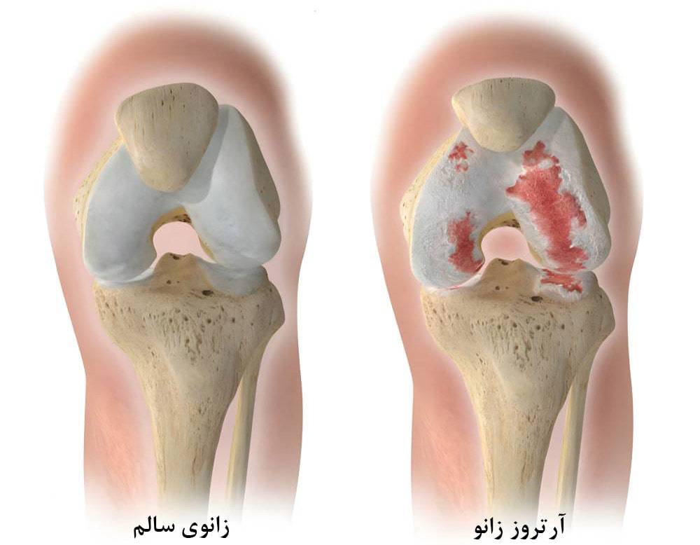 درد پشت زانو به علت آرتروز زانو