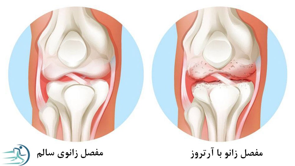 آب آوردن زانو بر اثر آرتروز