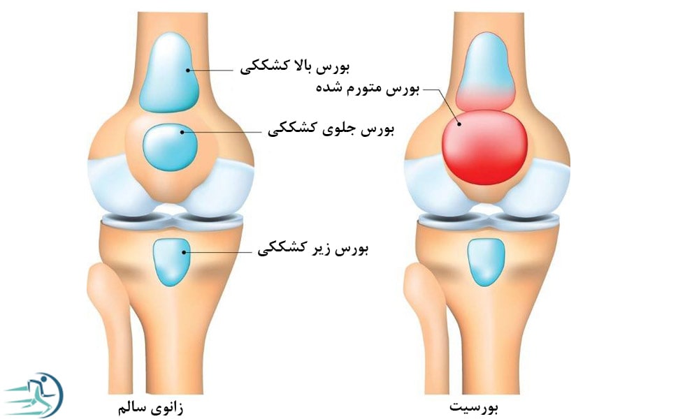 آب آوردن زانو بر اثر بورسیت