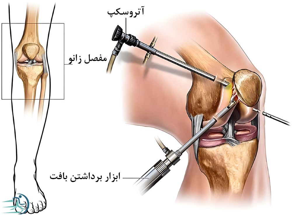 درمان آب آوردن زانو با جراحی آرتروسکوپی