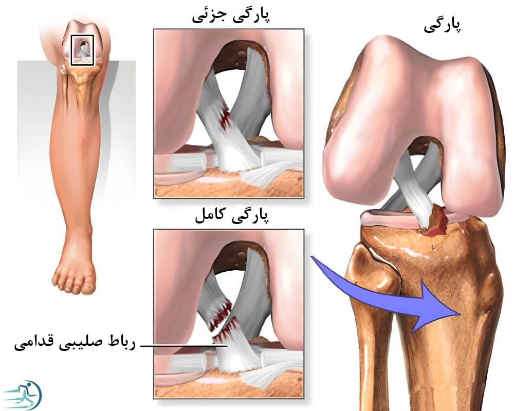 پارگی رباط ACL از علل آب آوردن زانو