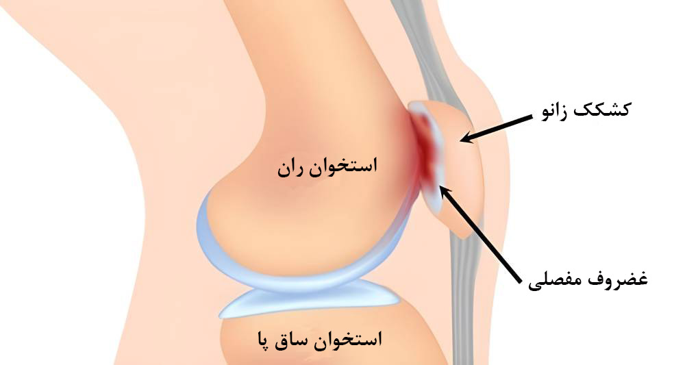 سندرم زانو درد پاتلوفمورال 