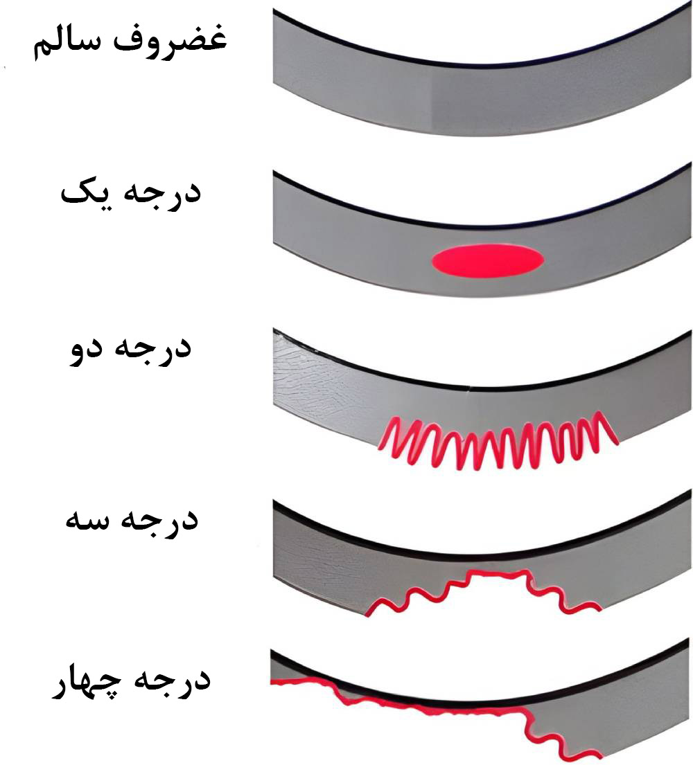 شدت کندرومالاسی