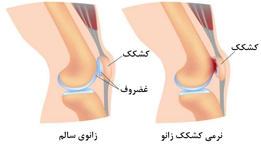 نرمی کشکک زانو یا کندرومالاسی چیست؟