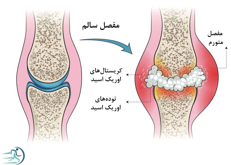 آب آوردن زانو بر اثر نقرس