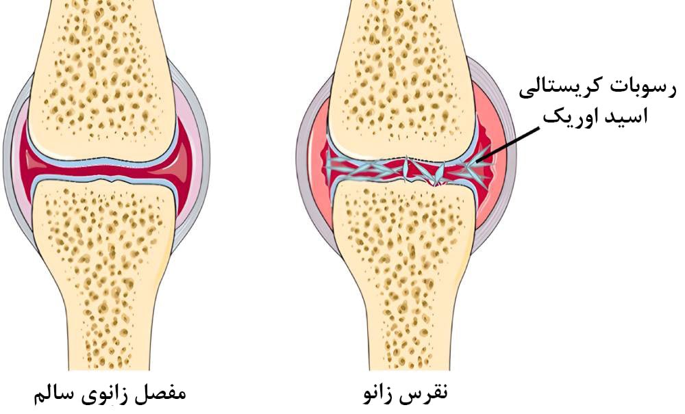 نقرس زانو چیست؟