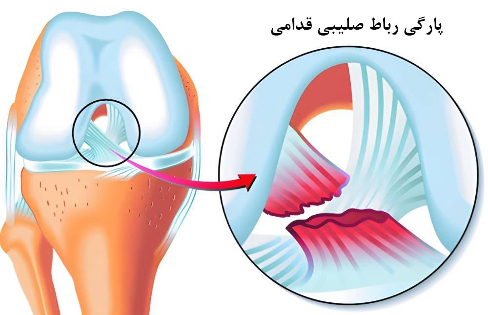 پارگی رباط صلیبی چیست