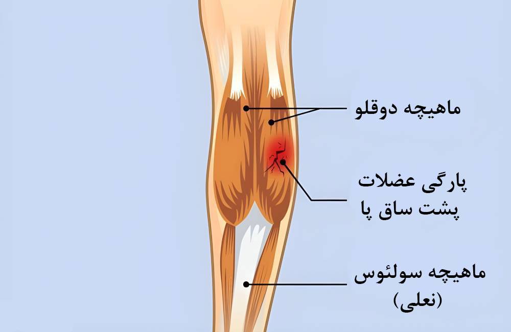 درد پشت زانو به علت پارگی و کشیدگی عضلات دوقلو (گاستروکنمیوس)