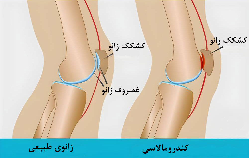 کندرومالاسی کشکک زانو (زانوی دونده) چیست