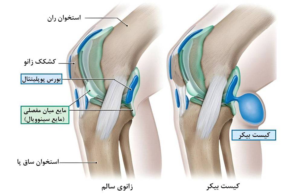 درد پشت زانو به علت کیست بِیکر