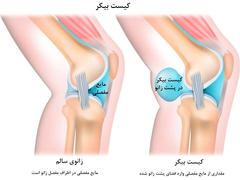 کیست بیکر چیست